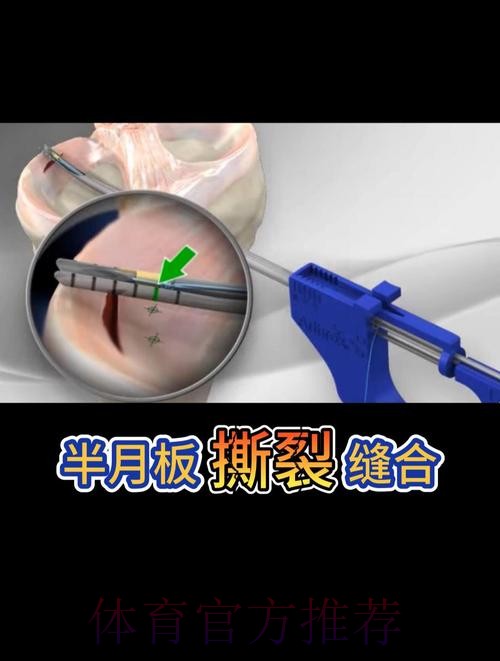 官方:阿拉巴成功接受了左膝内侧半月板撕裂手术 官方:阿拉巴成功接受了左膝内侧半月板撕裂手术